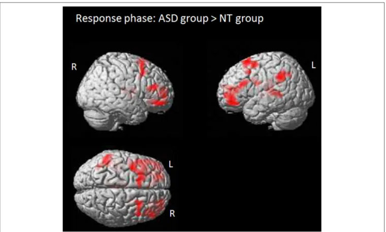 FIGURE 3 | Response phase: activation maps for the contrast ASD group &gt; NT group. Colored regions indicate significantly activated voxels with T &gt; 5.0, P FWE−corr ≤ 0.001, cluster level.