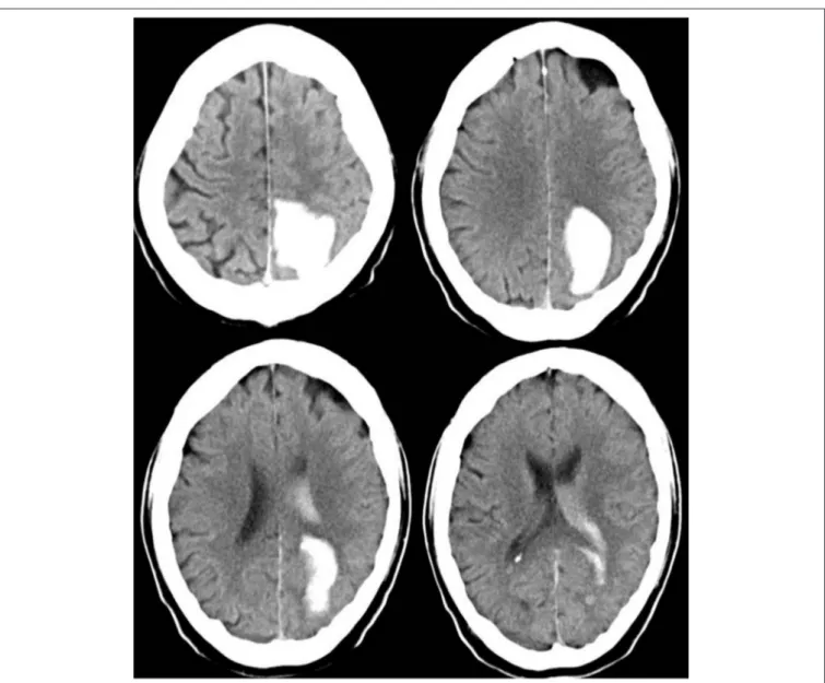 FIGURE 3 | cCT scan of a 63-year old man, acquired between 4.5 and 12 h after symptom onset, showing left occipital ICH