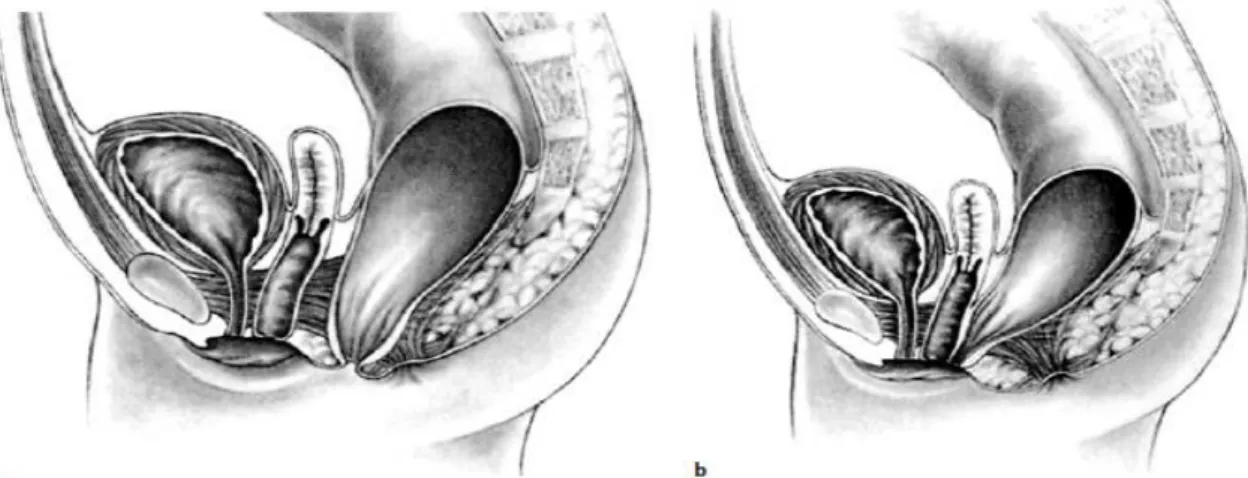 Abbildung 4: Darstellung der häufigsten Fistelformen der Analatresie bei Mädchen (12) 