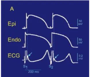 Abbildung  3:  Die  J-Welle  im  Oberflächen-EKG  unter  Einfluss  des  epikardialen  Aktionspotentials
