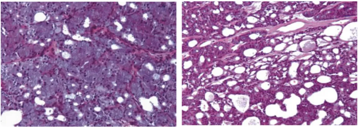 Abb. 1.3: Azinuszellkarzinom mit solidem (Bild 1) und mikrozystischem (Bild 2)  Wachstumsmuster (Peel RL