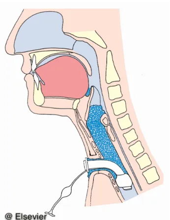 Abbildung 5. Versorgung mit der geblockten Trachealkanüle 
