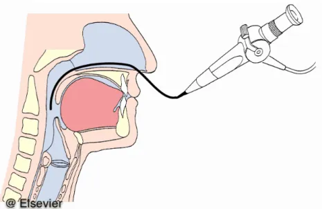 Abbildung 7. Transnasale fiberoptische endoskopische Schluckuntersuchung  