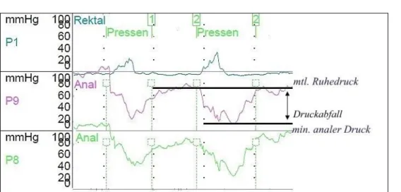 Abbildung  7.  Aufzeichnung  des  Pressversuchs  mit  rektalem  Druckanstieg,  maximalem  analen Druckabfall und analen Druck (ID Nr