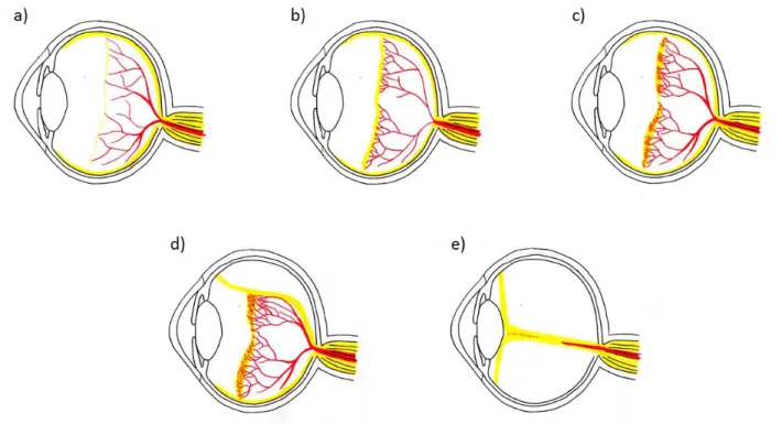 Abbildung 5: Darstellungen der verschiedenen Stadien der Frühgeborenenretinopathie (nach Hellstrom et al