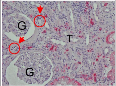 Abbildung  11  Banff  2. Akute  Antikörper-vermittelte  Abstoßung  (20x).  G = Glomerulum, T = Tubulus