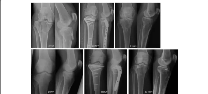 Fig. 1 Radiographs showing preoperative, postoperative, and long-term condition after tibial head fracture