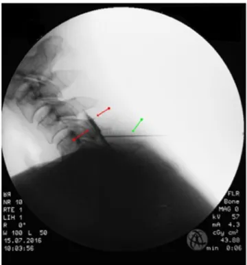 Figure 2.  Typical pattern of epidural contrast agent distribution between red arrows; green arrow: needle.