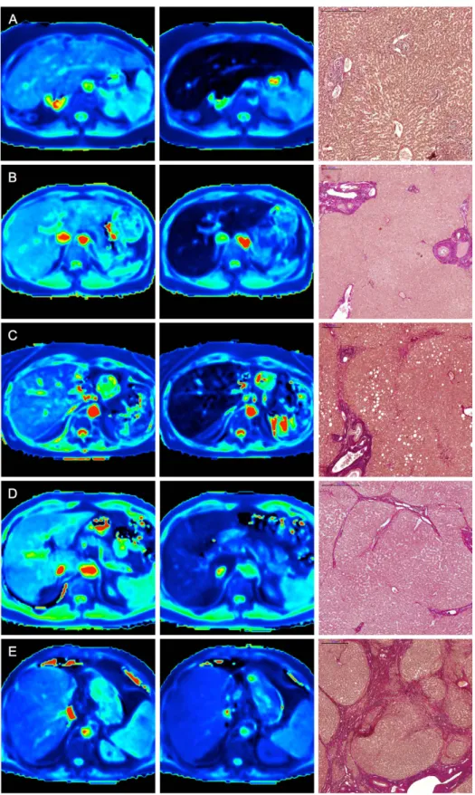 Figure 3.  T1 maps and histopathological images. Color-coded T1 maps comparing the precontrast and  hepatobiliary phases of a patient with normal liver parenchyma (F0, A) and those of patients with different  stages of liver fibrosis (METAVIR stages F1–F4,