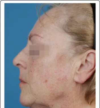 Fig. 1 Potential study patient. Face of a potential study participant with Glogau Photodamage Classification Type III (advanced)