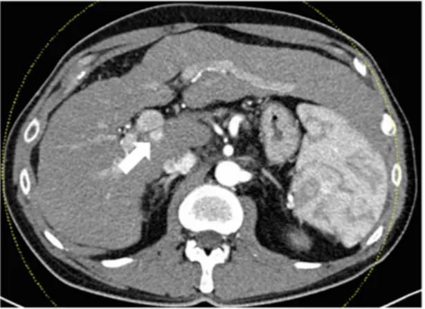 Figure 1.  52-year-old patient with hepatocellular carcinoma. Pre-interventional computed tomography for  intervention planning: arterial hypervascularized mass on the transition to liver segment I posterior to the main  stem of the portal vein.