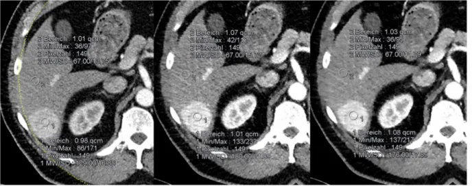 Figure 1.  Large HCC in liver segment VI. The lesion contrast-to-noise ratio is significantly higher using  SAFIRE than in FBP (4.6 at 120 kV; 7.2 at 80 kV IR3 and 9.2 at 80 kV IR5).