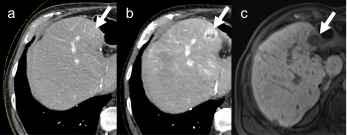 Figure 2.  HCC detected on MRI in hepatobiliary phase (c). The arrow shows the HCC. (a) Barely visible at a  tube voltage of 120 kV