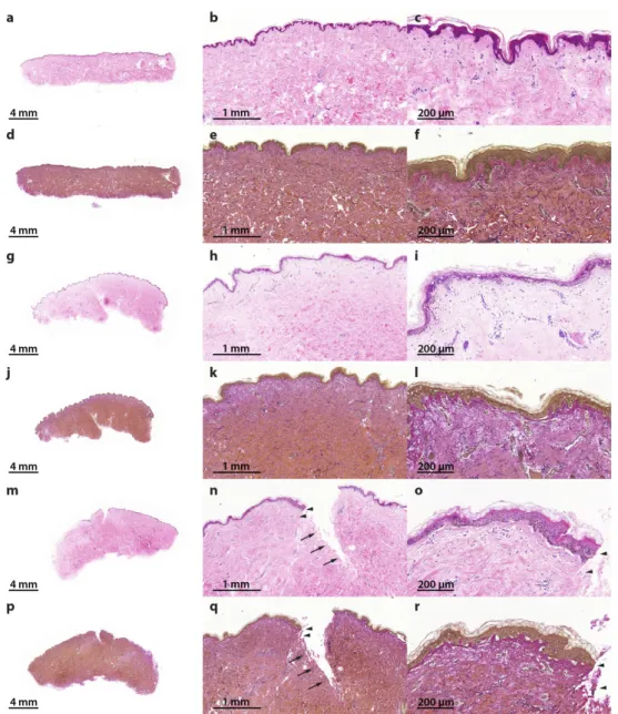 Figure 2. Hematoxylin–eosin (HE) and Elastica-van-Gieson (EvG) staining of patient 1 show vital skin  structure at all times of investigation without necrosis or inflammation: reference samples, 0 day (HE  (a–c); EvG (d–f); 0.5× (a,d), 3.5× (b,e) and 11.5×