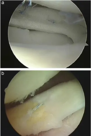 Abbildung  1.6  a:  Arthroskopische  An- An-naht eines Actifit®-Scaffolds an den  nati-ven  Meniskus;  b:  Relook-Arthroskopie  nach 24 Monaten