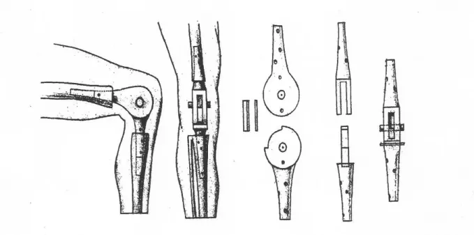 Figure 4: First models of prosthesis of Themistokles Gluck {Rabenseifner 1998 #34} 