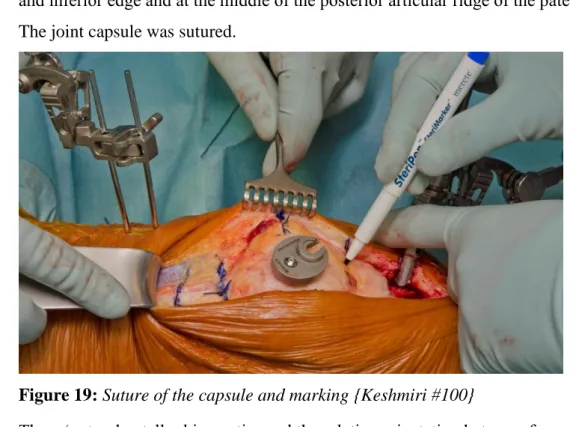 Figure 19: Suture of the capsule and marking {Keshmiri #100} 