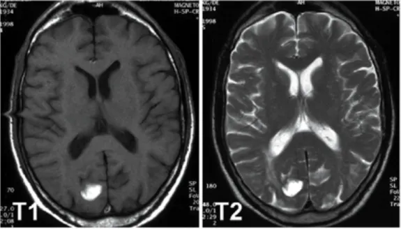 Abbildung  2  Nebeneinanderstellung  einer  T1-  und  einer  T2-Sequenz  in  der  MRT  eines  Patienten mit zerebraler Blutung okzipital, Flüssigkeit (hier gut zu sehen an den Ventrikeln)  in T1 dunkel, in T2 hell