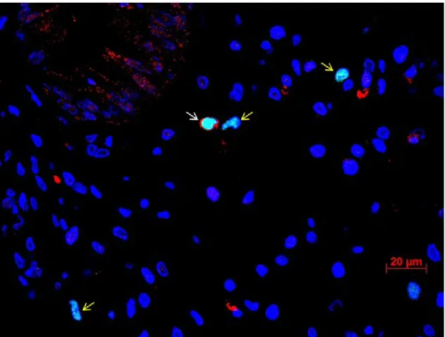 Figure 5.8: Foxp3 + CD4 +  double staining of colon tissue of GvHD patient. 