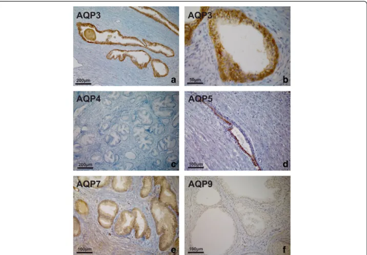 Fig. 3 AQP immunoperoxidase labelling of non-malignant prostatic tissues (BPH). Intense expression of AQP 3 throughout the epithelium from a patient with BPH