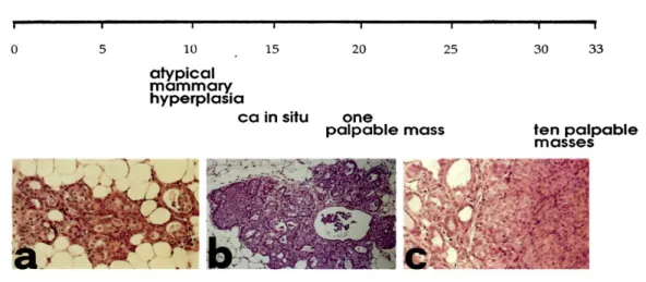 Figure 5.  Progression  of  HER-2/neu  carcinogenesis  in  untreated  Balb–NeuT.  Histology  shows  that  ductular  atypical  hyperplasia  (a)  is  already evident and widely distributed in all mammary glands at 3 weeks of age