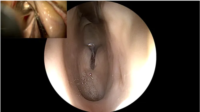 Abb. 1: Endoskop – Blick in den 3.Ventrikel (nach Passage des Foramen Monroi) 