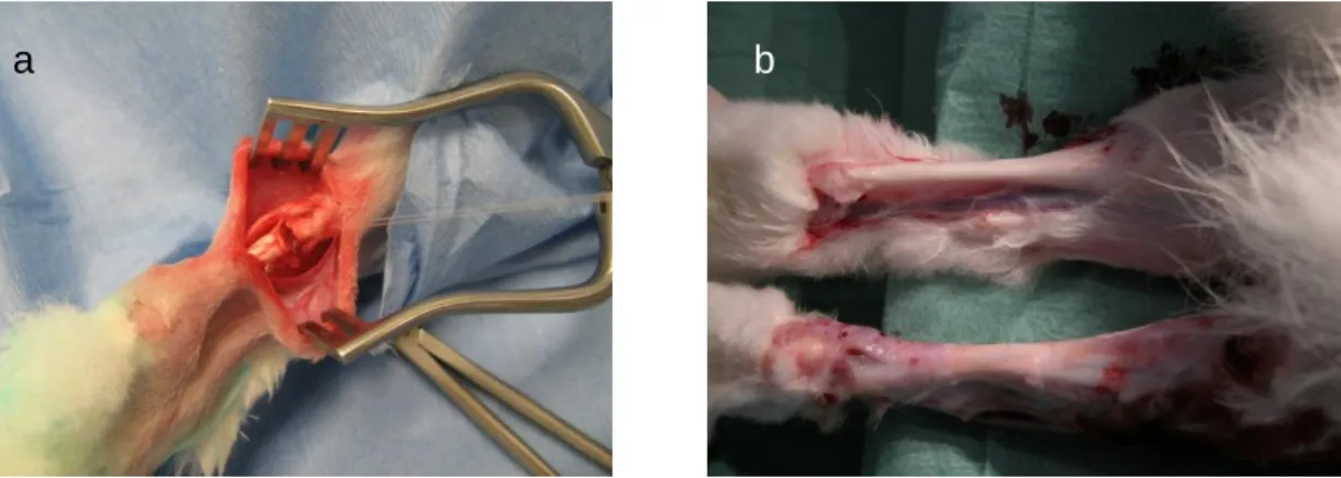 Figure  4:  After  gastrocnemius  tendon  dissection  insertion  of  the  collagen  matrix  and  fixation with a modified Kessler suture technique (a)