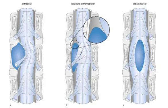 Abbildung 2: Tumorlokalisation. Anatomische Lage spinaler raumfordernder Läsionen. a) extradural,  b) intradural/extramedullär, c) intramedullär [Wiesmann M