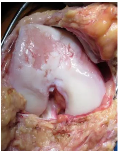 Abbildung  1-1:  Intraoperatives  Bild  eines  rechten  Knies  mit  einem  großen  Knorpelschaden  der  seitlichen  und  zentralen  Trochlea