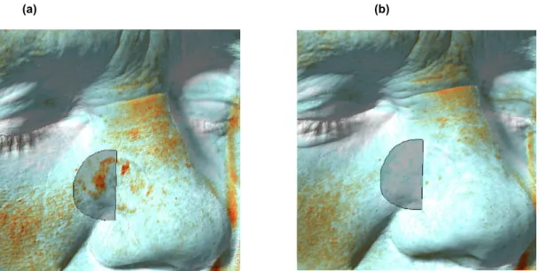 Abbildung 6:   Melaninverteilung vor der Lasertherapie mit eingezeichneter zu analysierender Fläche (a) und  Melaninverteilung 1 Jahr nach der letzten Lasertherapie mit eingezeichneter, identischer zu analysierender  Fläche (b)