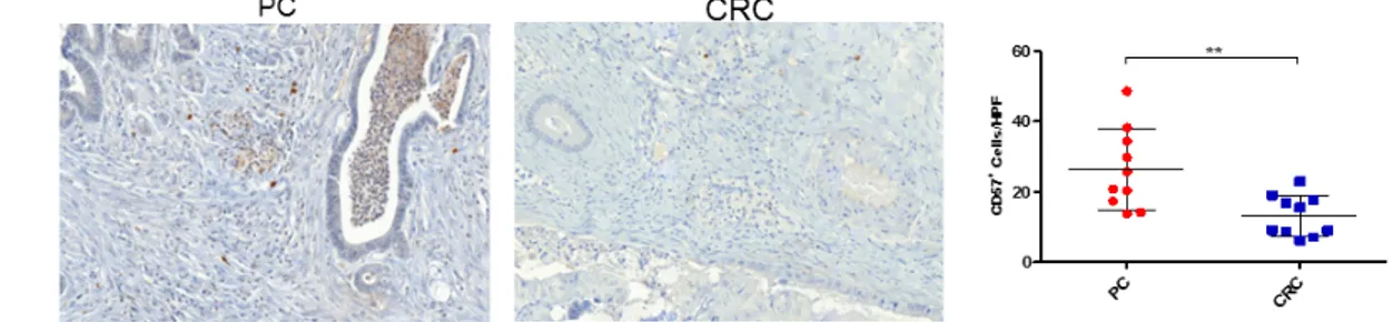 Abb.  8:  Immunhistochemische  Auswertungen  der  NK-Zell-Färbung  anhand  des  NK- NK-Zellmarkers CD57 in Biopsien der Peritonealkarzinose und des kolorektalen Karzinoms  Um  zu  untersuchen,  wie  sich  die  Zytotoxizität  der  Immunzellen  bei  örtliche