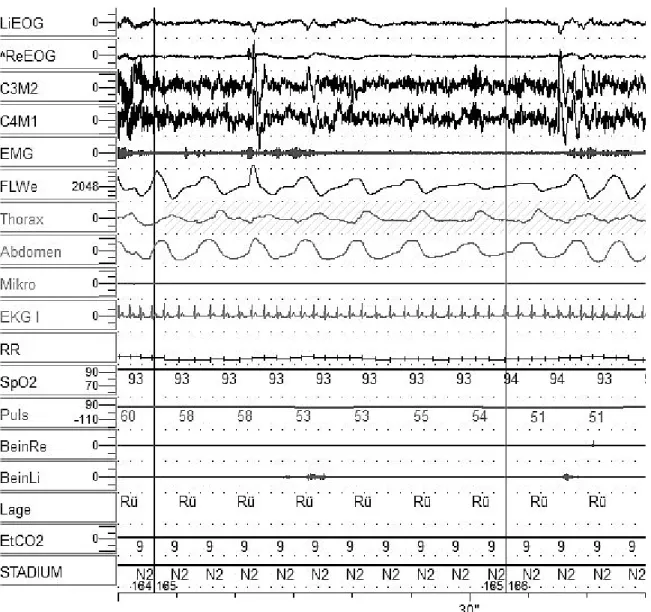 Abbildung 1 Ausschnitt aus einer Polysomnographie, LiEOG/^ ReOG = Elektrookulographie  links/rechts C3M2/C4M1=  zwei Ableitungspunkte der Elektroenzephalographie (EEG); EMG= 