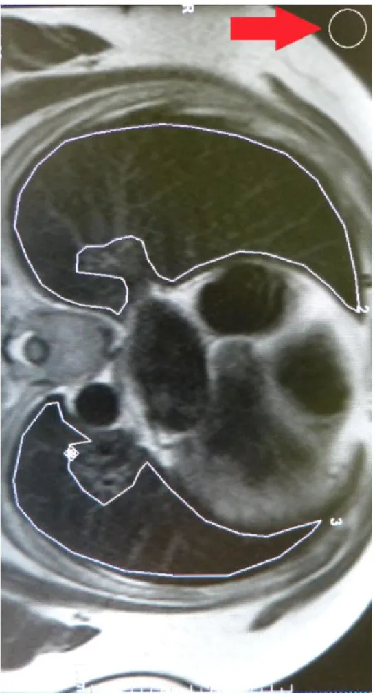 Abbildung 4 MRT Aufnahme: Basale Höhe direkt über dem Zwerchfell mit eingezeichneten ROIs in  den beiden Lungenhälften; Pfeil = ROI für Hintergrundrauschen