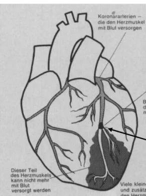 Abb. 3 Der Herzinfarkt (Kloos 1988, 64)