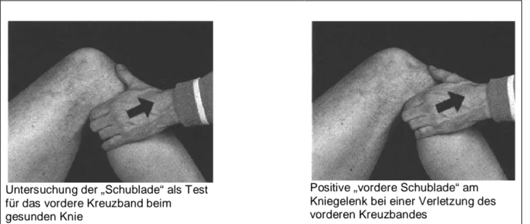 Abb. 6 Der „Vordere Schubladen-Test“(Peterson/Renström 1987, 292)