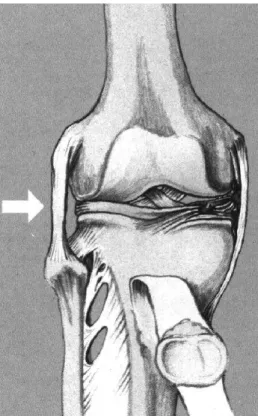Abb. 4 Unterschiedliche Stadien einer Kniegelenkschädigung als Folge einer Krafteinwirkung gegen die Aussenseite des rechten Knies