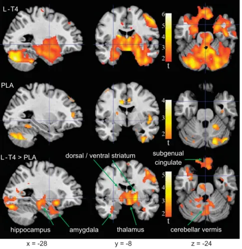 Figure 3. Brain areas where change in relative activity after treatment was correlated with change in depressed mood (Hamilton Rating Scale for Depression (HamD 17 ))