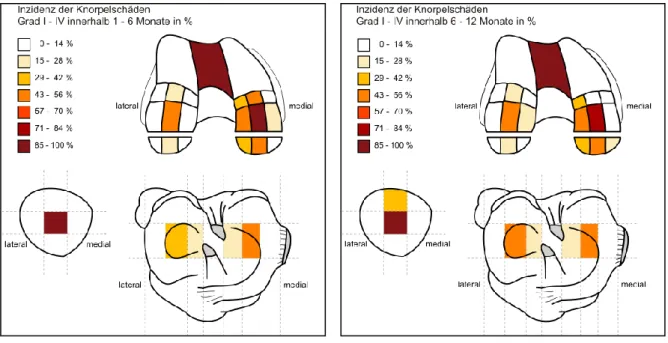 Abb. 11 und 12: Knorpelschäden der Grade I - IV (Links: Abb. 11: innerhalb ein bis  sechs Monate, rechts: Abb