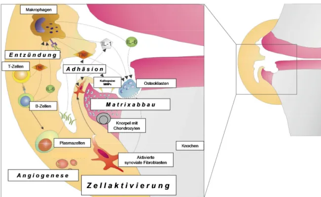 Abbildung 1: Mechanismus der Gelenkzerstörung bei rheumatoider Arthritis  (Modifiziert nach Neumann et al