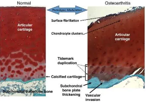 Figure 3: Anatomy of normal and osteoarthritic articular cartilage and subchondral bone  