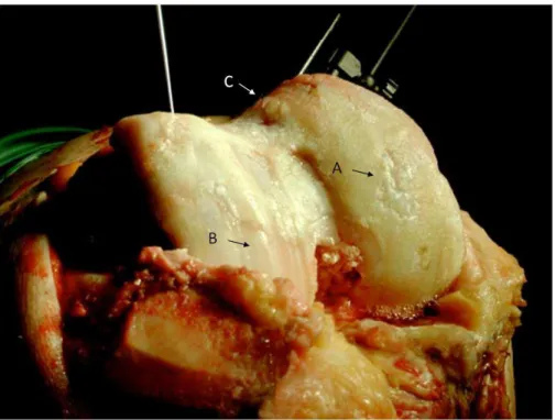 Figure 6: Representative photo of an osteoarthritic (OA) knee joint during knee surgery  