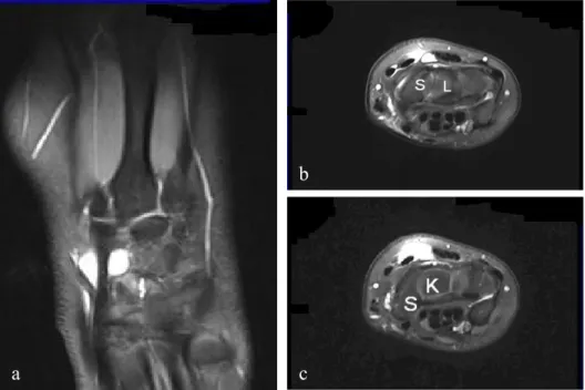 Abb.   5:   MRT   eines   Handgelenks   mit   extraartikulärem   Ganglion   im   frontalen   und   axialen   Schnitt