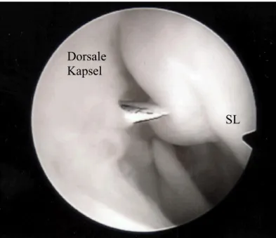 Abb.   8:   Arthroskopisches   Bild   eines radiodorsalen   Ganglions,   rechtes   Handgelenk, Blick vom 6R-Portal auf die dorsale Kapsel