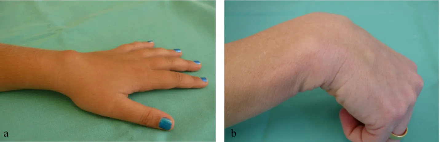 Abb. 3: Typisches sichtbares dorsoradiales Handgelenksganglion (a) und nur bei Handgelenksbeugung sichtbares dorsoradiales Ganglion (b)