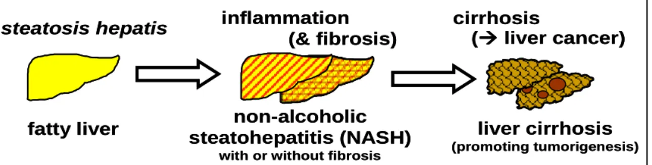 Figure  2.1  The  spectrum  of  NAFLD:  fatty  liver  (steatosis  hepatis),  non-alcoholic  steatohepatitis  (NASH) with or without fibrosis, and liver cirrhosis, which promotes development of liver cancers