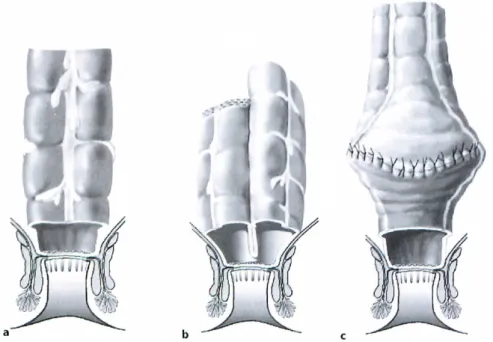 Abbildung 6: a-c Rekonstruktionsformen. a kolonale End-zu-End-Anastomose, b Kolon-J- Kolon-J-Pouch, c transverser Koloplastik-Pouch (Willis und Schumpelick 2010)