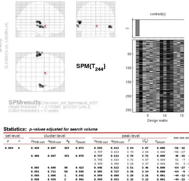 Abb. 5: Übersicht der Ergebnisse der Kovarianzanalyse für den für subjektive Hörschwierigkeiten korrigierten Score des Tinnitus Fragebo- Fragebo-gens als unabhängige Variable