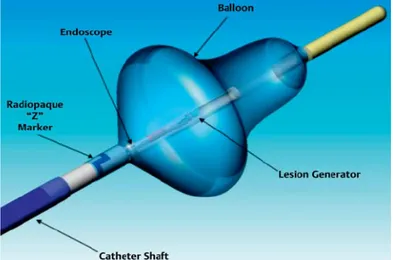 Abb.  2:  Schematische  Darstellung  des  Endoskopie-gesteuerten  Laserballon- Laserballon-Ablationskatheters 