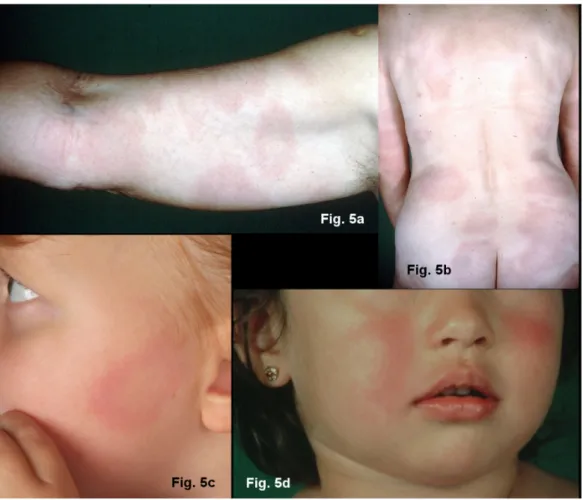 Figure 5: Multiple erythemata migrantia (MEM)