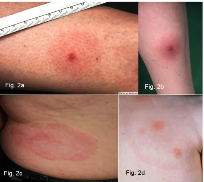 Figure 2: Clinical variations of erythema migrans